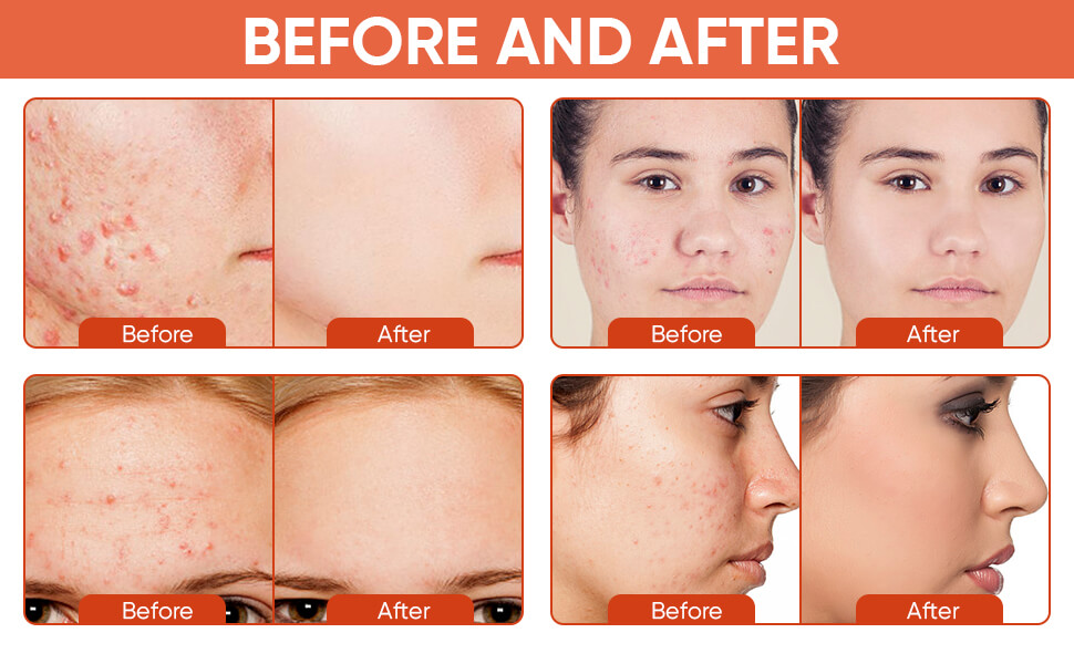 Skinoren Cream Before and After Use Results - Order Online Now Available in best Price in Pakistan